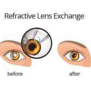 Refractive Lens Exchange