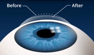 Lasik eye surgery