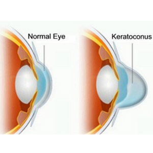 Keratoconus
