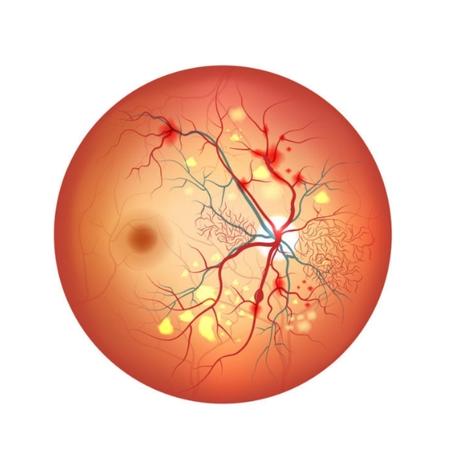 Diabetic Retinopathy
